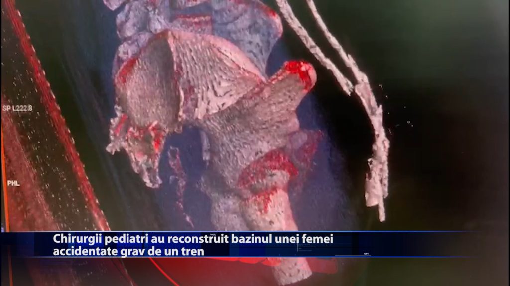 Chirurgii pediatri au reconstruit bazinul unei fete accidentate grav de un tren