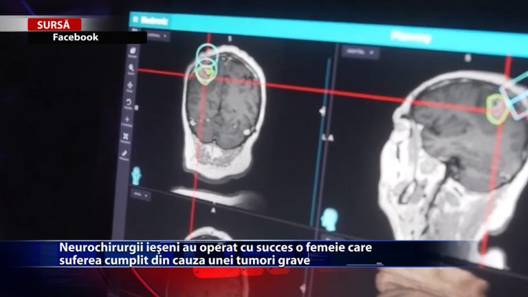 Neurochirurgii ieșeni au operat cu succes o femeie care suferea cumplit din cauza unei tumori grave