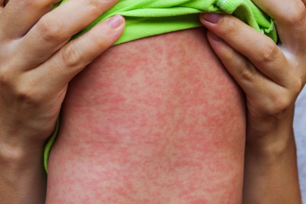 In ultima saptamana, in judetul Iasi au inregistrate cinci cazuri noi de rujeola
