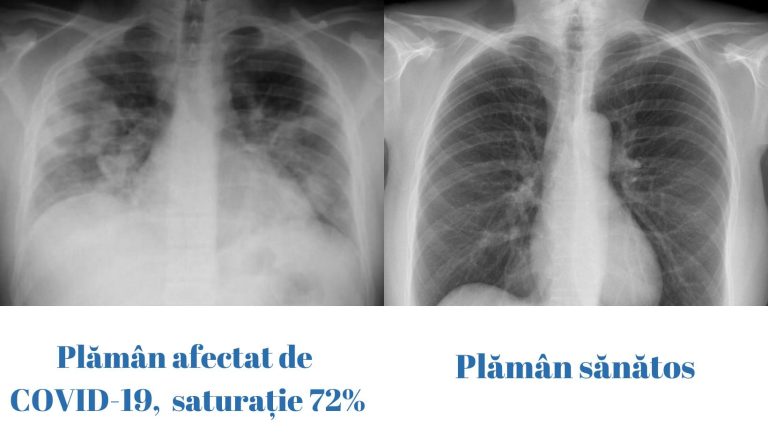 Plămân afectat de COVID-19 VS plămân sănătos