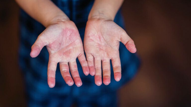 Copilă de șase ani suspectată de scarlatină, internată la Iași