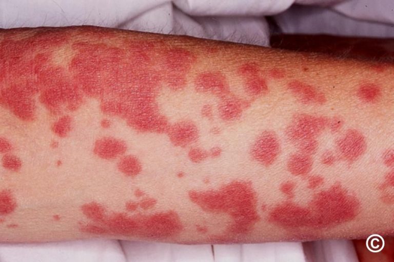 Un copil de 9 ani cu sindrom rar Stevens-Johnson, tratat la Spitalul de Boli Infecţioase „Sf. Parascheva” din Iaşi