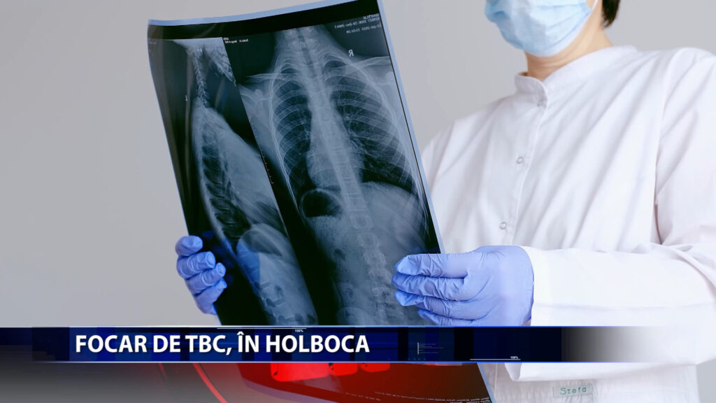 FOCAR DE TBC IN HOLBOCA