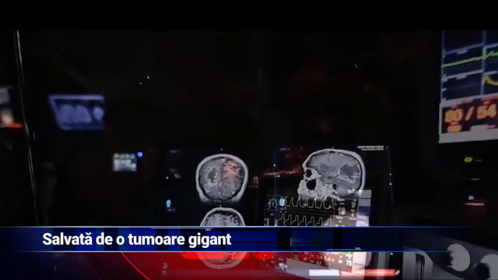 Salvată de o tumoare gigant