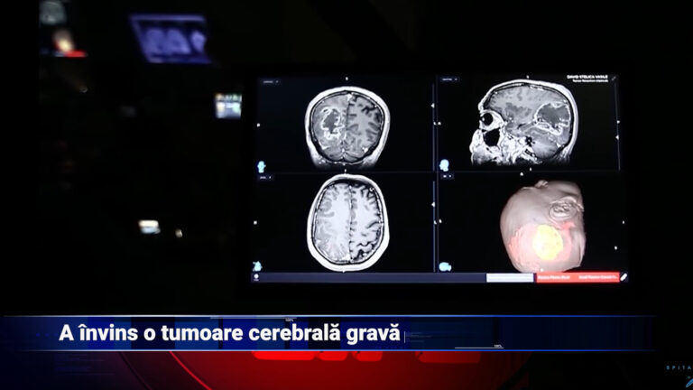 A învins o tumoră cerebrală gravă