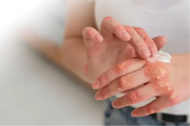 Trei angajați ai unui salon de masaj, diagnosticați cu lepră